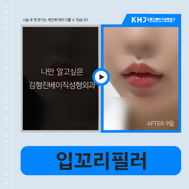 압구정입꼬리필러 전문인 곳에서 고민 해결! 관련 이미지 6