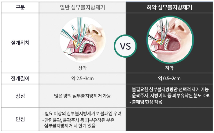 남자볼살제거 어설프게 말고 관련 이미지 5