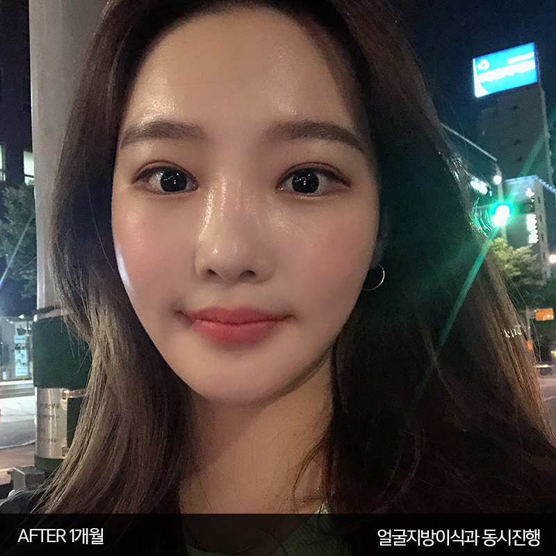 얼굴지흡붓기 김형진베이직은 달라요 관련 이미지 4