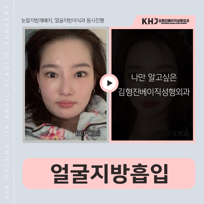 얼굴지방흡입후기 바로 여기에요! 관련 이미지 3