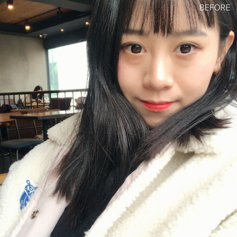 눈밑지방재배치회복과정이 빠를 수밖에 없는 이유 관련 이미지 2