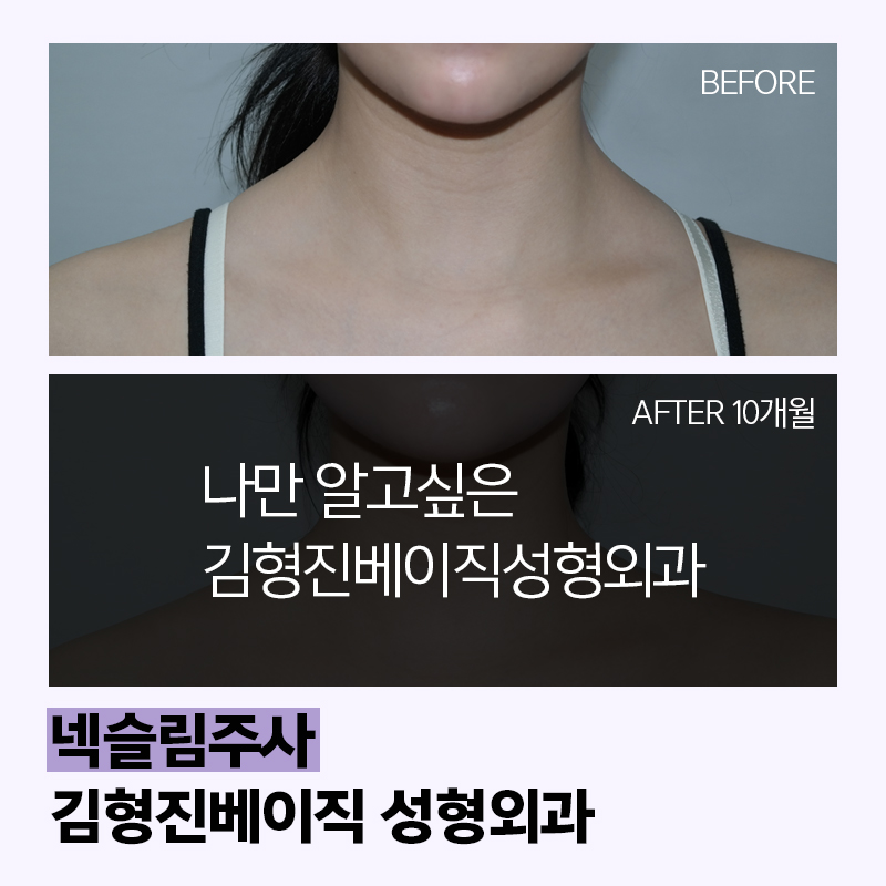 넥슬림주사로 이쁜 목라인 만들기 관련 이미지 2