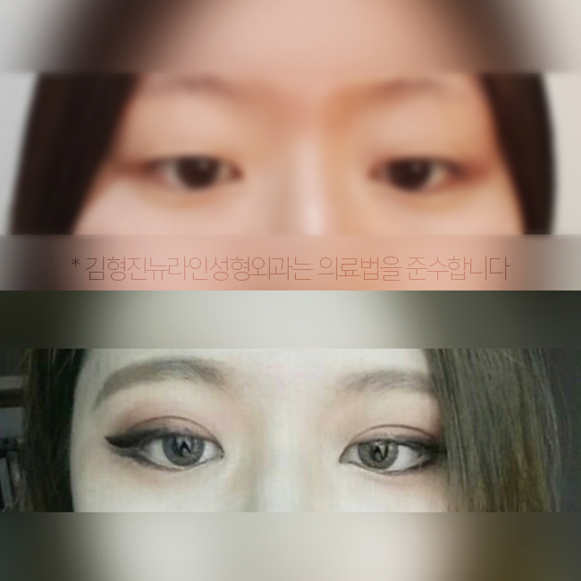 학생 쌍수 후기 리얼로 보니 하고 싶잖아~ 관련 이미지 3