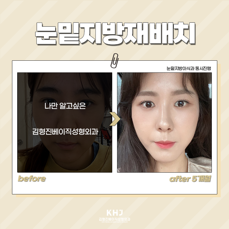 눈밑지방재배치회복기간 빠를 수밖에 없는 이유! 관련 이미지 3