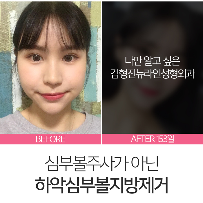 심부볼주사 이걸론 절대 못 빼요 관련 이미지 3