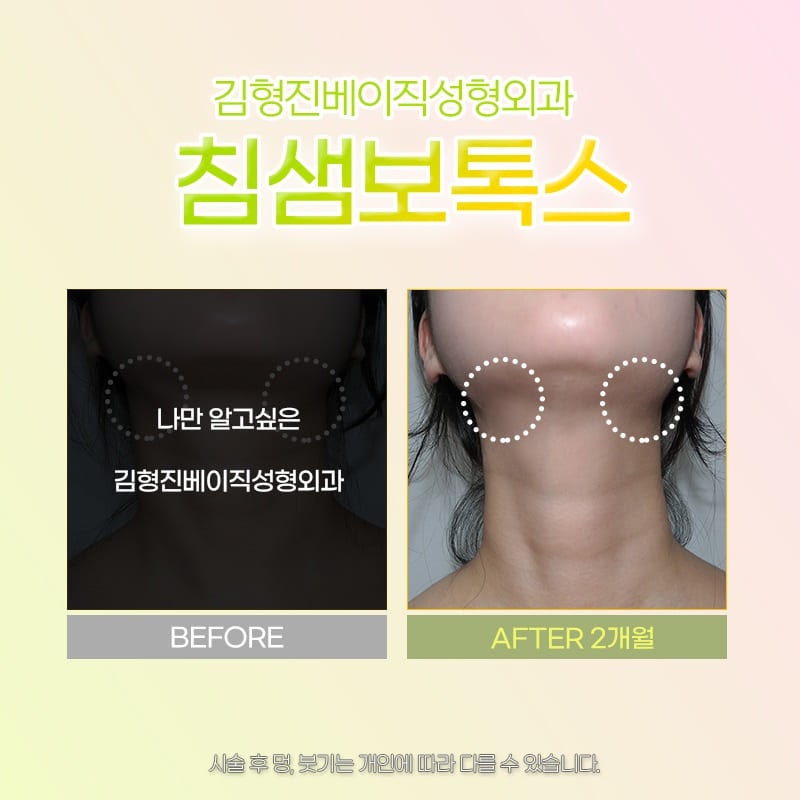 침샘비대증 치료하고 날렵한 턱선 만들었어요! 관련 이미지 6