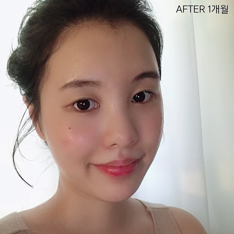 심부볼제거술, 확실한 볼살제거 방법 관련 이미지 6