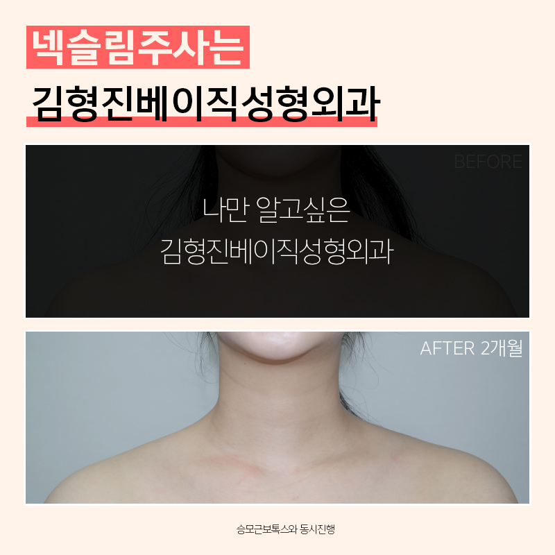 두꺼운목선, 과연 갸름해질 수 있을까? 관련 이미지 3