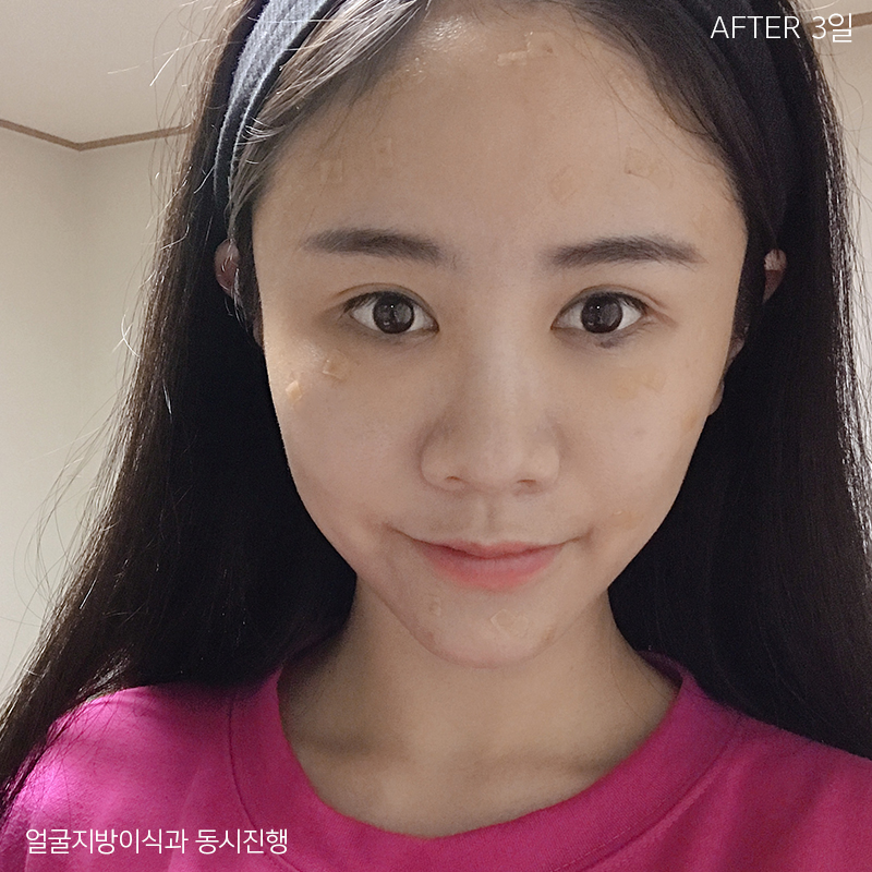 눈밑지방재배치회복과정이 빠를 수밖에 없는 이유 관련 이미지 3