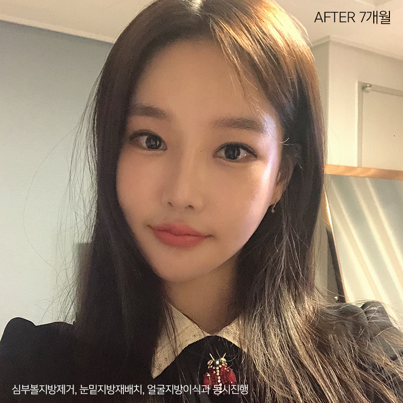 이중턱제거효과 아직 모르세요? 관련 이미지 5