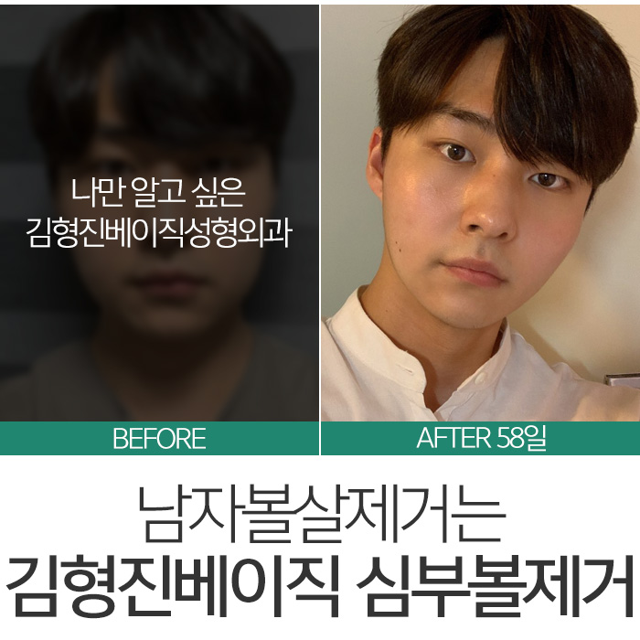 남자볼살제거 어설프게 말고 관련 이미지 7