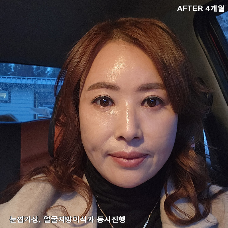 중년눈밑지방개선 어떤 방법이 있냐구요? 관련 이미지 6