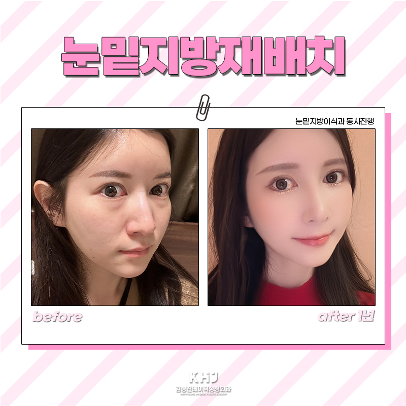 지저분한 눈 밑? 재발 걱정 없는 압구정눈밑지방제거로 해결! 관련 이미지 6