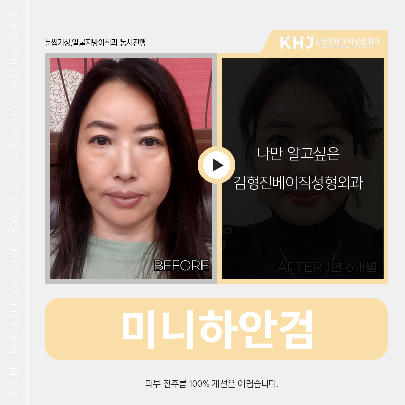 중년눈밑처짐 수술방법 알려드려요! 관련 이미지 4