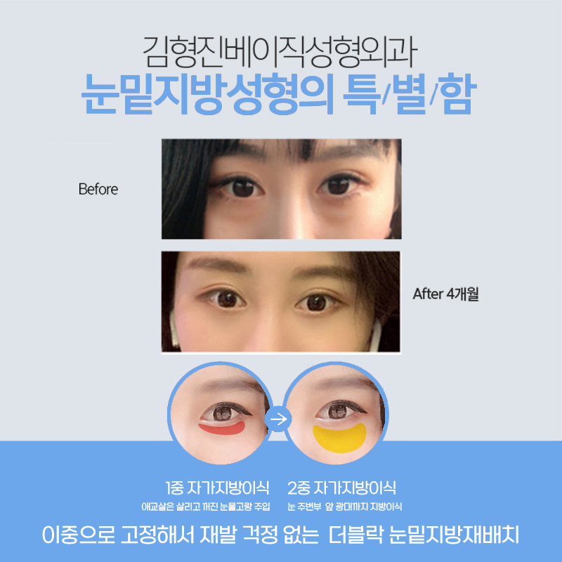 빠르게 눈밑지방없애는방법으로 선택한 눈밑지방재배치, 후회 없어요 관련 이미지 4