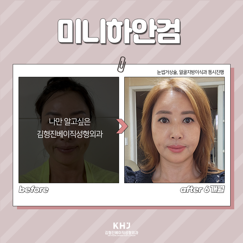 미니하안검효과 이렇게나 다양해! 관련 이미지 5