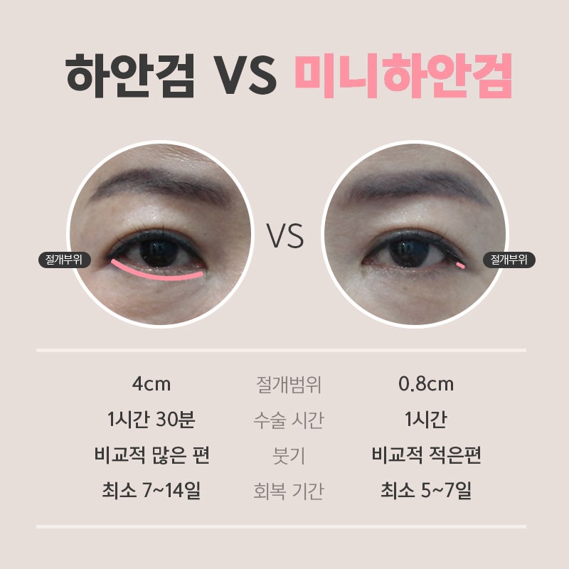 강남하안검 부작용이 걱정된다면 미니하안검으로 관련 이미지 3