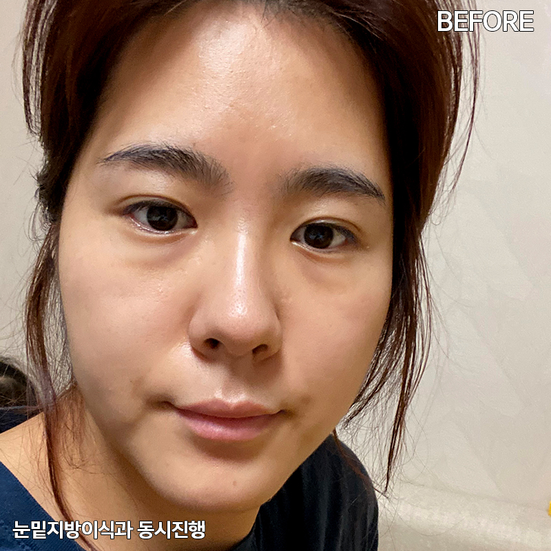 눈밑지방재배치유지력 하면 김형진베이직 관련 이미지 2