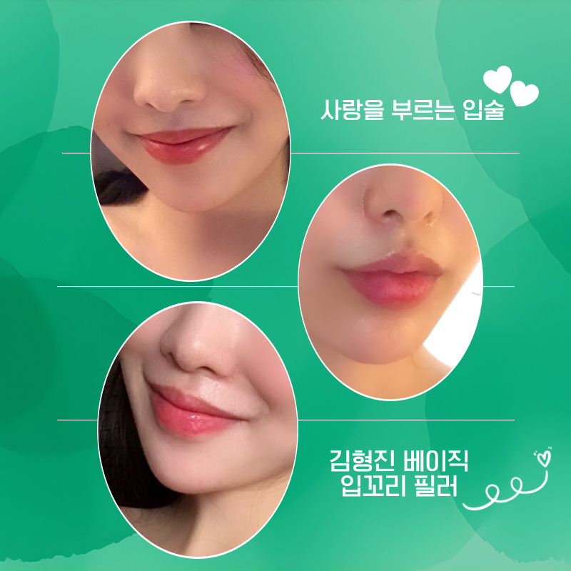 You can create more vibrant lips with just a mouth-corner filler procedure! image 4