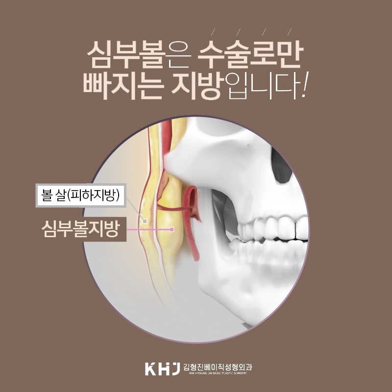 압구정심부볼제거 심술보 같은 불독살이 고민이라면? 관련 이미지 4