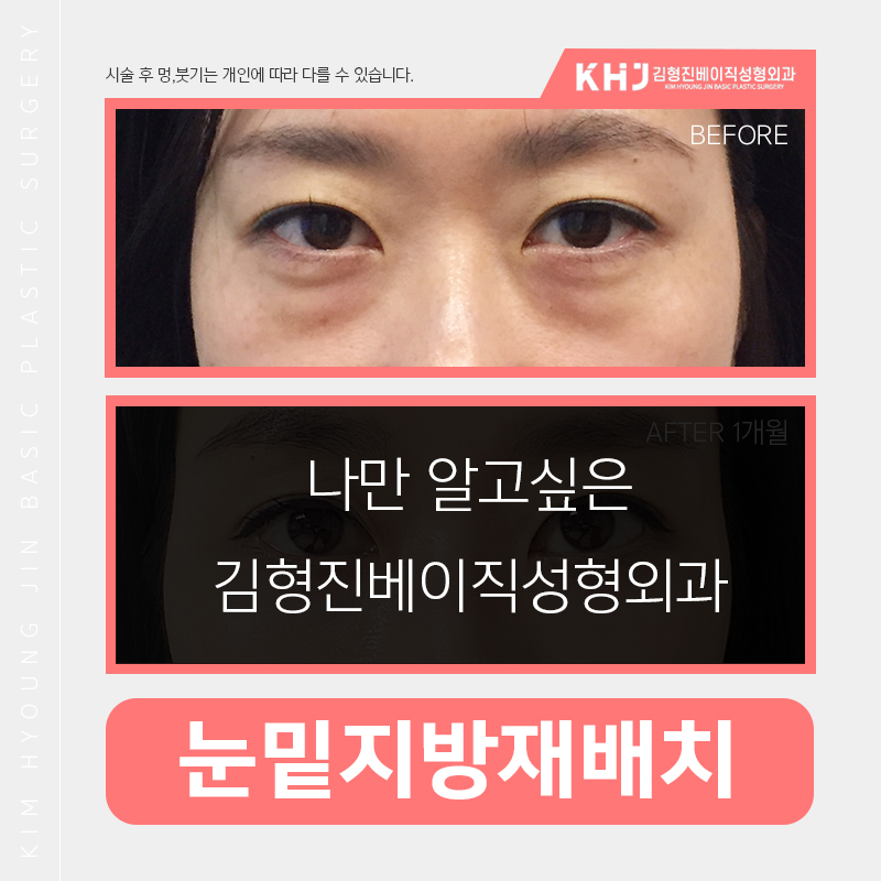 눈밑지방재배치흉터 보이지 않는 게 맞아요! 관련 이미지 3