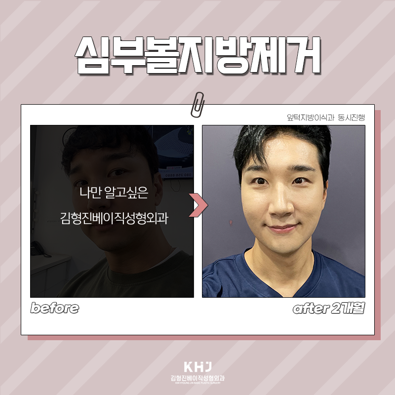 심부볼제거전후 궁금하셨다면 관련 이미지 3