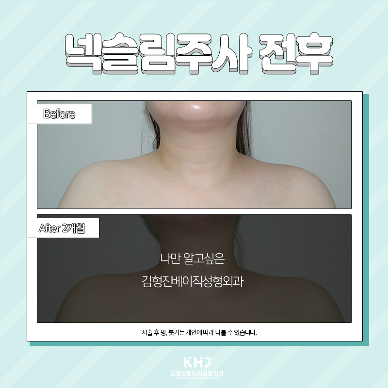 넥슬림주사효과 언제부터 볼 수 있냐면요 관련 이미지 4