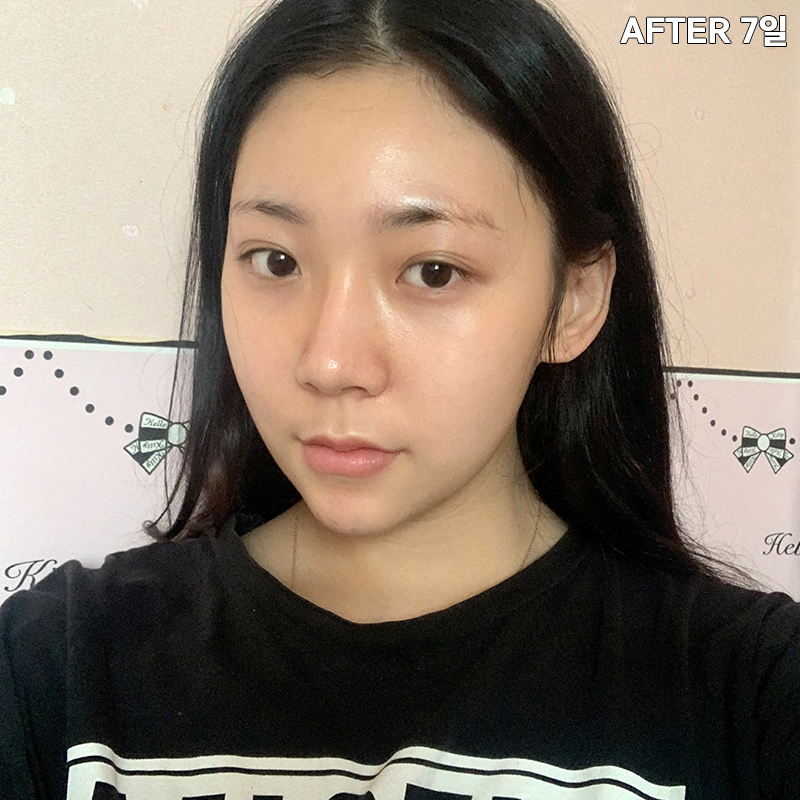 심부볼제거수술을 왜 받냐구요? 관련 이미지 4