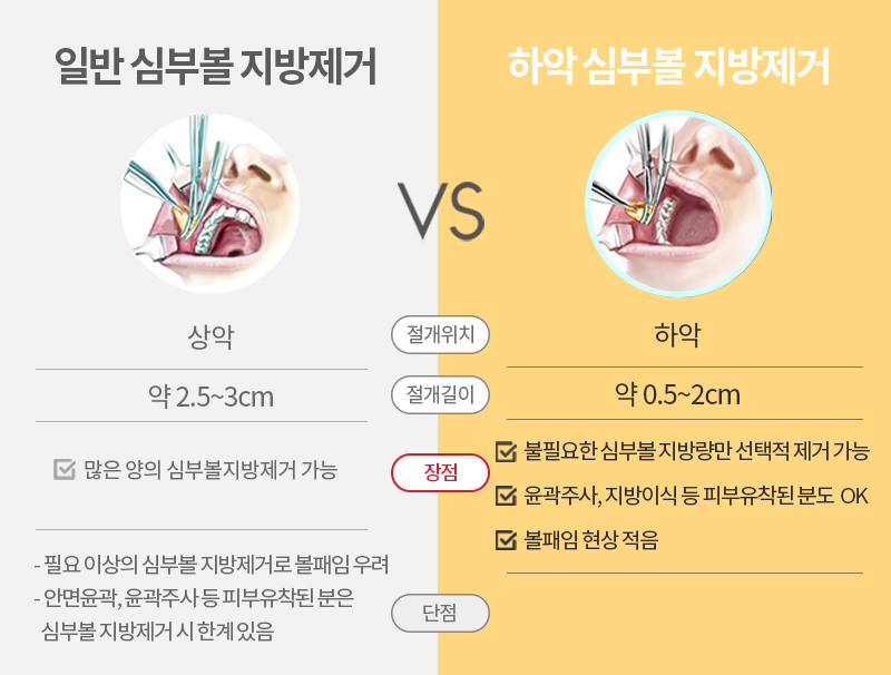 심부볼제거 부작용 걱정 왜 해요? 관련 이미지 4