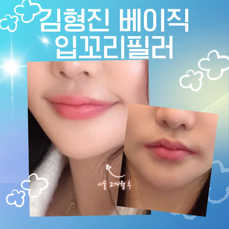 압구정입꼬리필러후기 이만큼 만족스러울 수가 없어요 관련 이미지 4