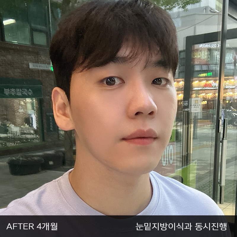 눈밑지방재배치수술이 궁금하시다면 관련 이미지 7