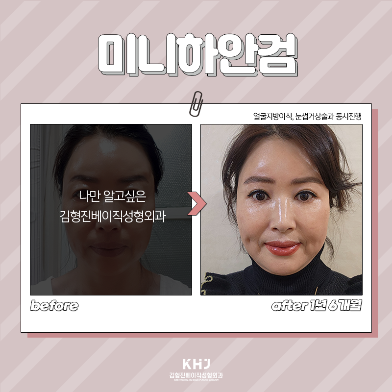 미니하안검절개 깔끔한 곳 찾으신다면 관련 이미지 5