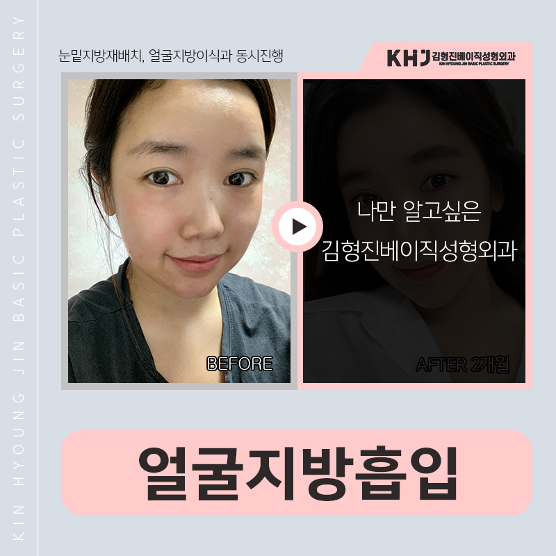 얼굴지방흡입후기 바로 여기에요! 관련 이미지 5