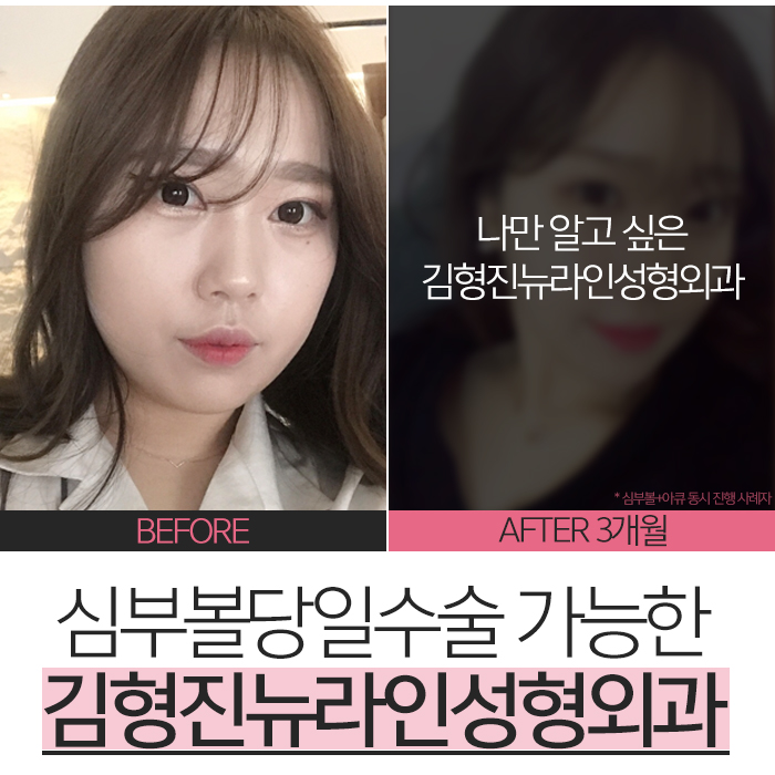 심부볼당일수술 그리고 만족한 결과! 관련 이미지 2