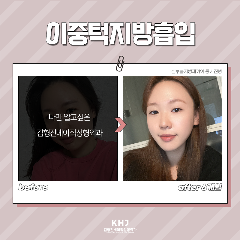 이중턱지방흡입수술 역시 김형진베이직이죠 관련 이미지 3