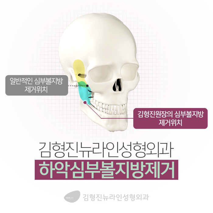 심술보제거 어떻게 하냐구? 관련 이미지 4