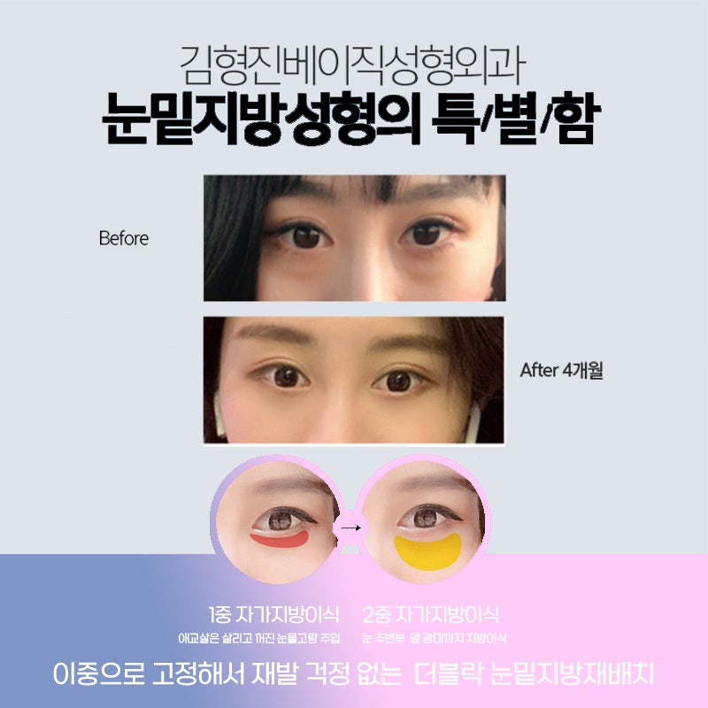 아직도 강남눈밑수술 잘하는 곳 못 찾았나요? 관련 이미지 4