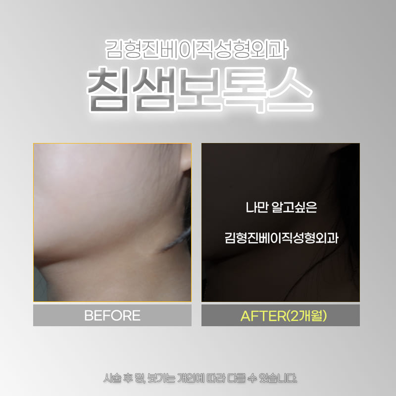침샘보톡스전후 돌고 돌아 결국 여기였어요 관련 이미지 5