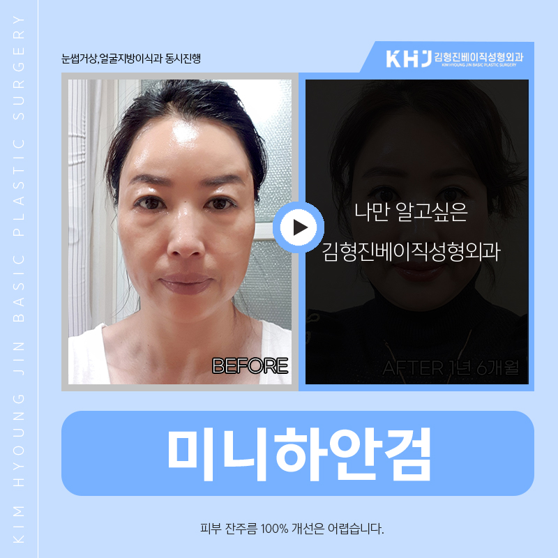 효도성형으로 젊음을 되찾아드리고 싶다면? 관련 이미지 3