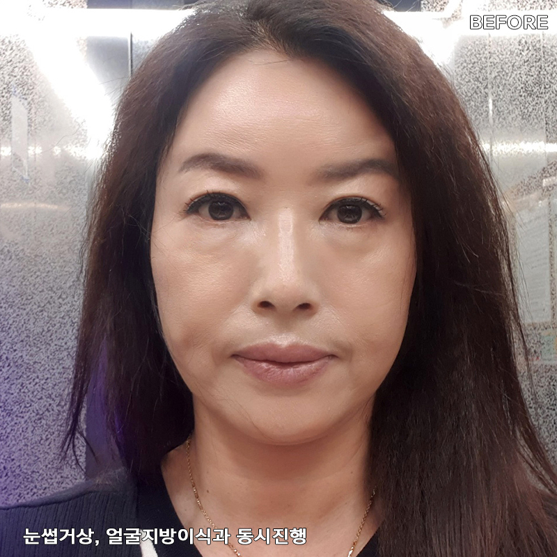 중년눈밑지방개선 어떤 방법이 있냐구요? 관련 이미지 2