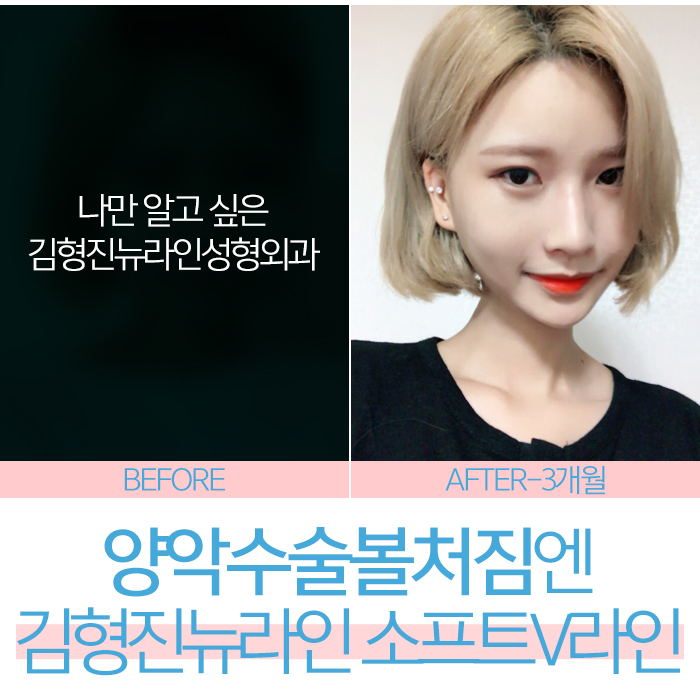 양악수술후볼처짐 두번 다신 없어야 해요 관련 이미지 7