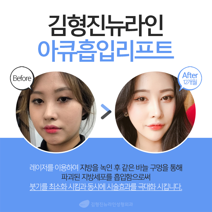 아큐스컬프 붓기 때문에 고민? 관련 이미지 4