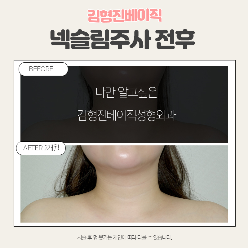 웨딩시술은 김형진베이직에서! 관련 이미지 5