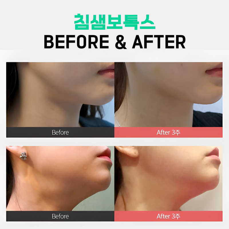 침샘보톡스전후 보고 바로 결정했어요 관련 이미지 5