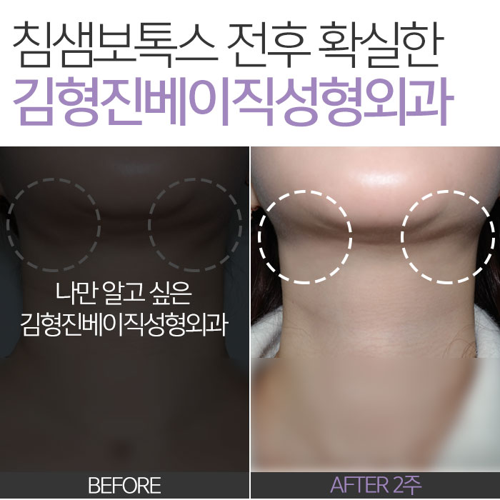 침샘보톡스전후 차이, 보이세요? 관련 이미지 8
