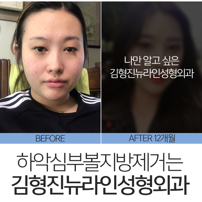 하악심부볼지방제거 보면 놀라요 관련 이미지 3