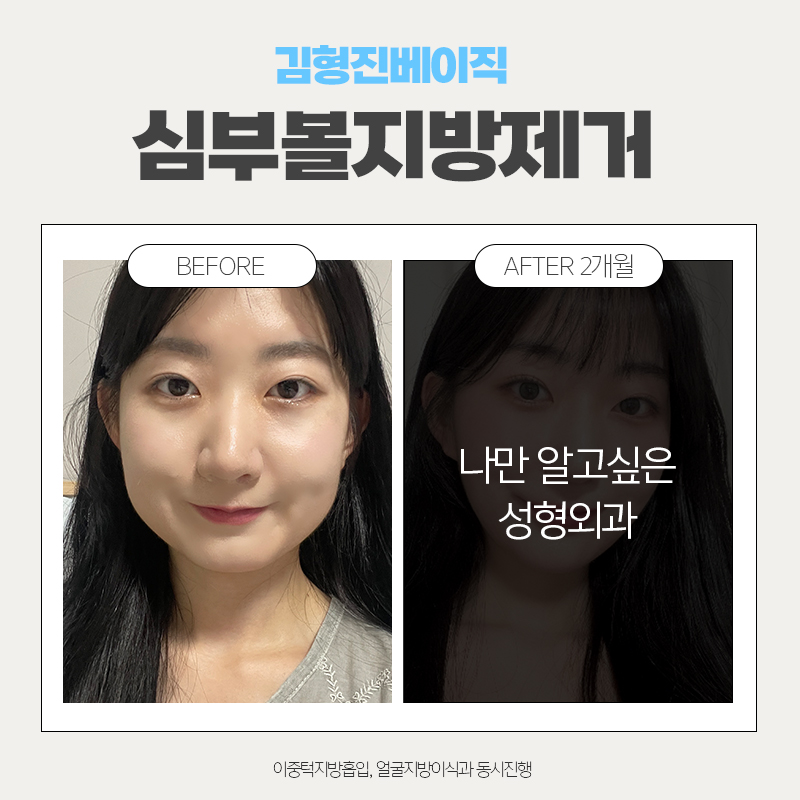 심부볼제거후기 이정도는 돼야죠 관련 이미지 2