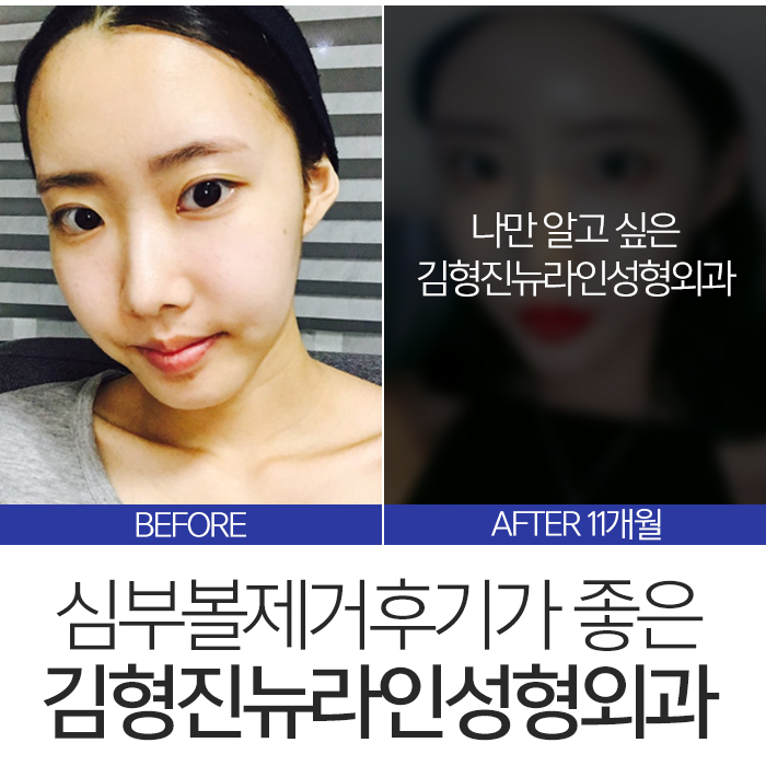 심부볼제거후기 좋을 수 밖에 없는 관련 이미지 8