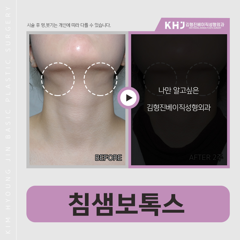 침샘보톡스후기 궁금하신분?? 관련 이미지 2