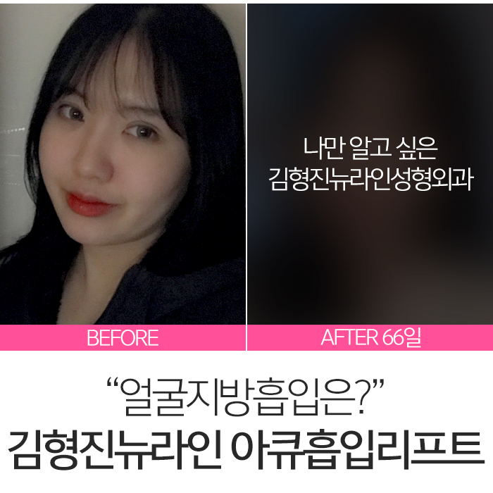 얼굴아큐스컬프 살빼는데 최고죠 관련 이미지 8